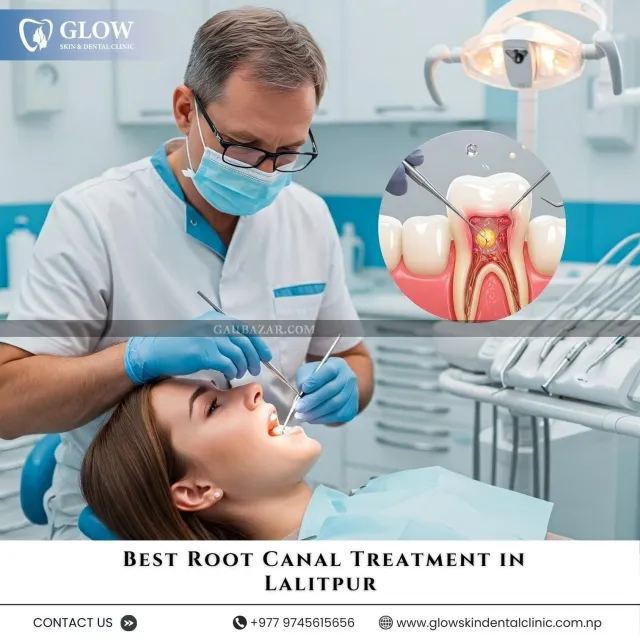 Best Root Canal Treatment in Lalitpur