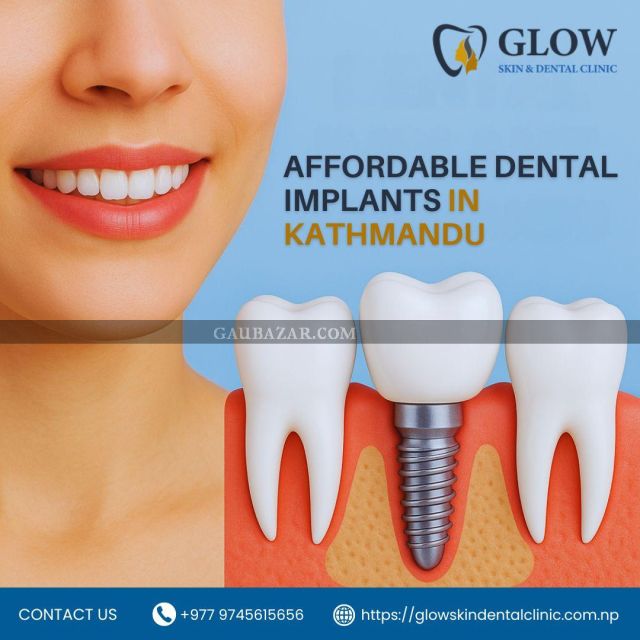 Affordable Dental Implants in Kathmandu